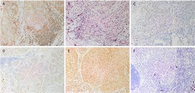 The Identification of Three Cancer Stem Cell Subpopulations within Moderately Differentiated Lip Squamous Cell Carcinoma